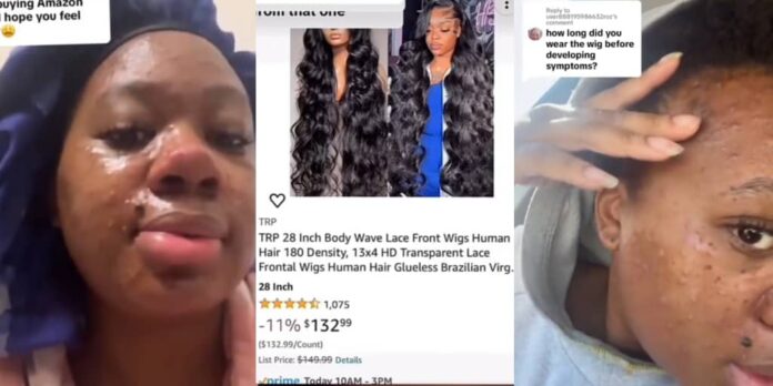 $132 Amazon Wig Leaves Woman with Painful Skin Condition – Ends Up in Hospital