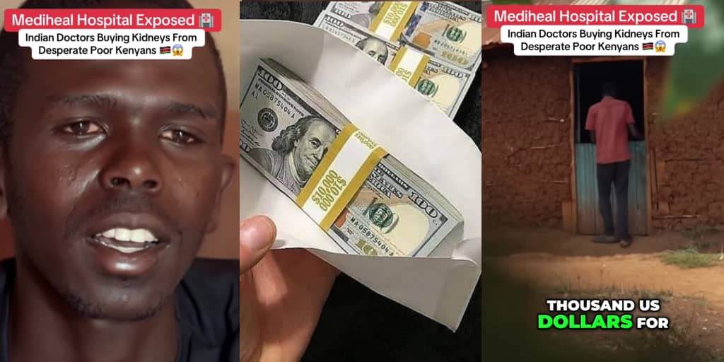 Doctors Accused of Buying Kidney for $6,000—Man Sells Organ for Cash in Shocking Deal