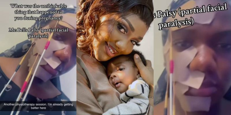 Mother Details Experience with Facial Paralysis Linked to Pregnancy